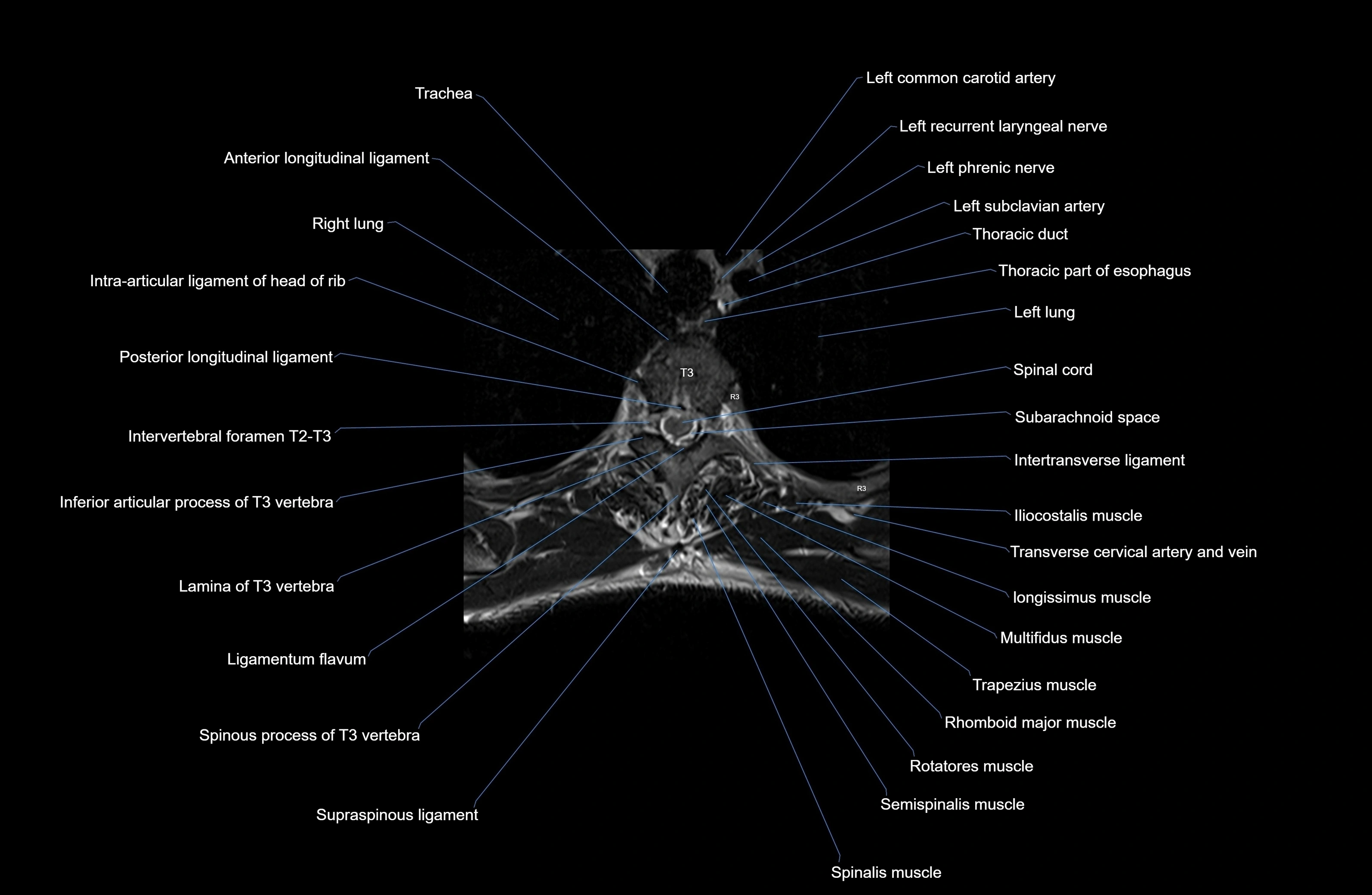 MRI thoracic spine axial  cross sectional anatomy 3T radiology  image-img-00001-00020.webp